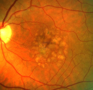 close-up photo of a retina: coloured