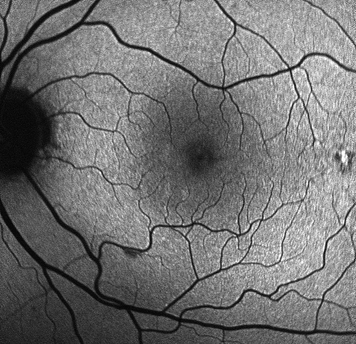 close-up photo of a retina